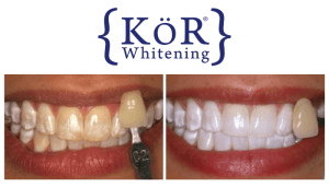 Kor Teeth Whitening