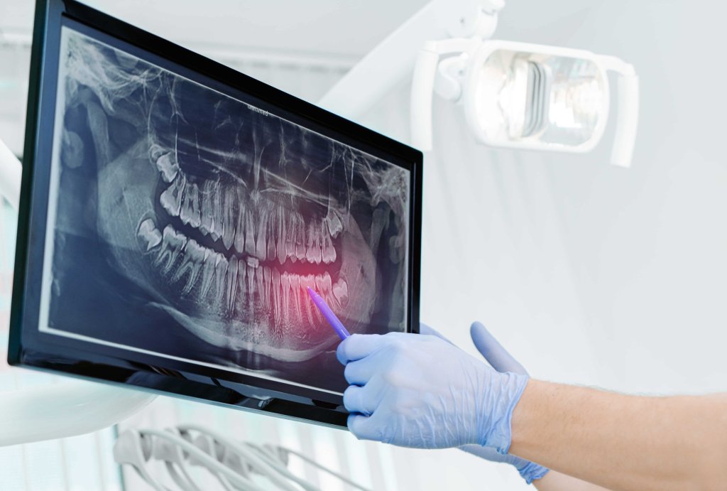 digital imaging scan of a full mouth of teach for dental implants