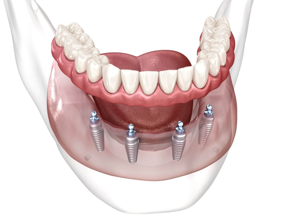 all-on-4 dental implants showing full arch dental implants on 4 posts