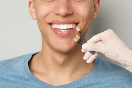 a dentist holding up different tooth color testers to match the tooth color of the patient for porcelain veneers