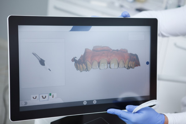 Digital image of scanned upper teeth using the Trios Intraoral Scanner